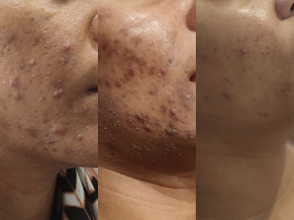 Peeling chimique - Institut de beauté Douceur de Lys à Rodez