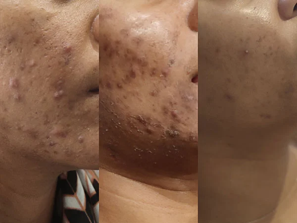 Peeling chimique - Institut de beauté Douceur de Lys à Rodez